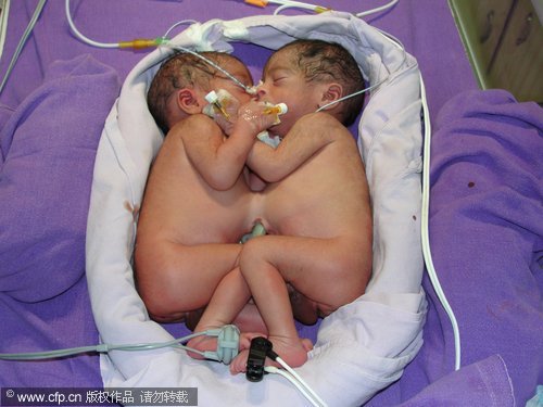 2-week-old conjoined twins separated in India