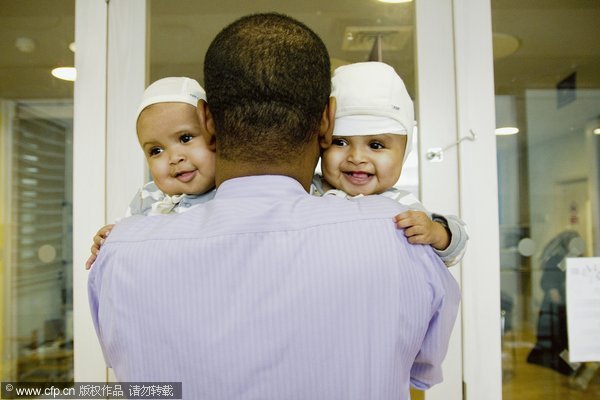 Conjoined twin girls separated