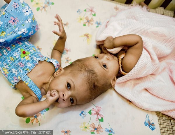 Conjoined twin girls separated