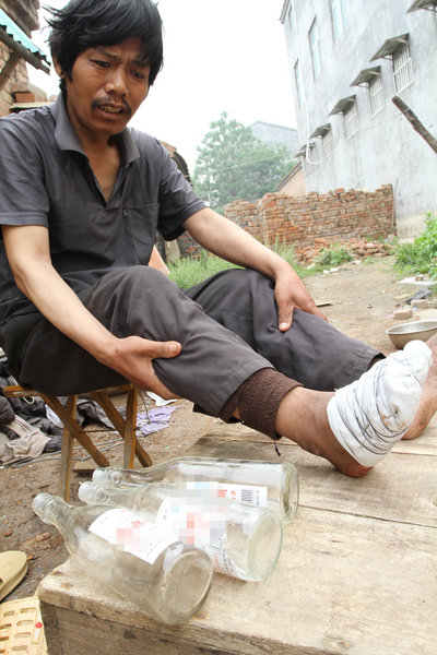Man loses five toes from overdrinking