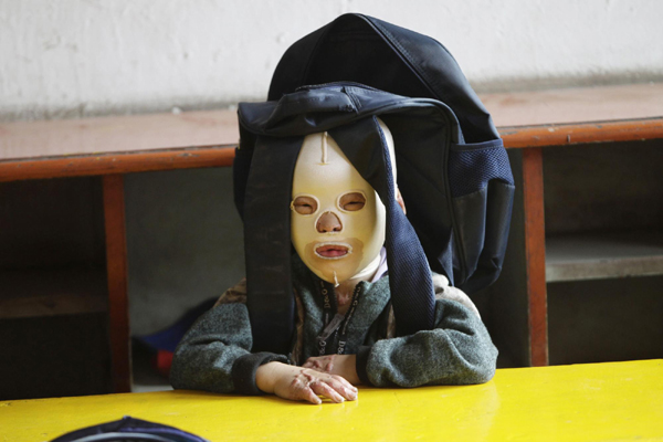 Masked boy barred from kindergarten due to burns