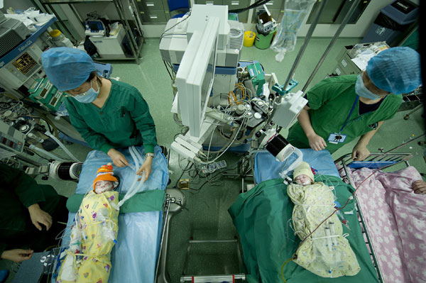 Chinese doctors seperate conjoined twins