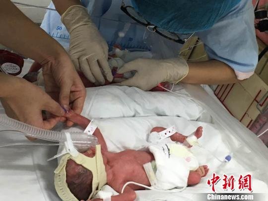 Identical natural quadruplets born in Shanghai: 1 in 13 million