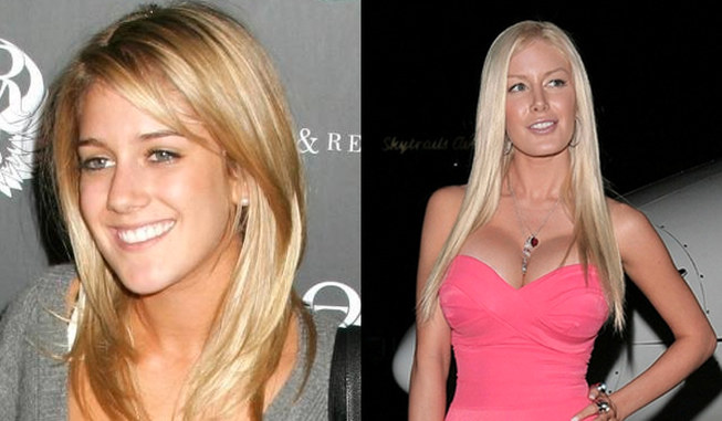 Worst celebrity plastic surgery fails