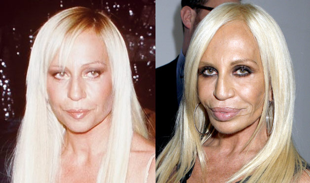 Worst celebrity plastic surgery fails