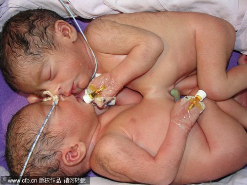 2-week-old conjoined twins separated in India