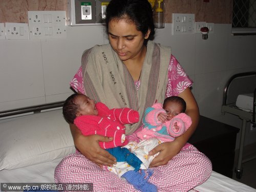 2-week-old conjoined twins separated in India