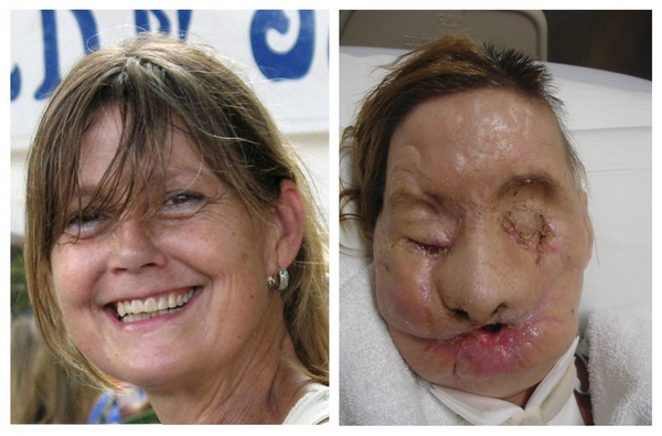 US woman gets full face transplant