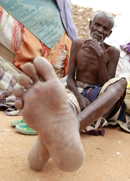 Displaced Somalis suffer from malnutrition