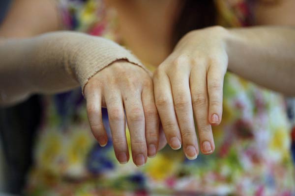 US woman to show off newly transplanted hand