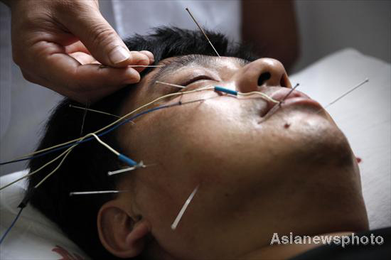 Acupuncture, Peking opera on UNESCO heritage list