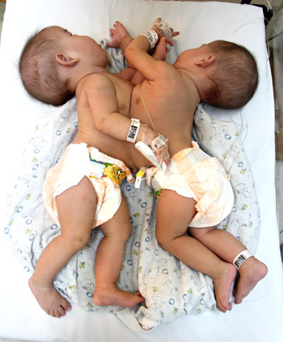 Conjoined twins recovering after 6-hr surgery