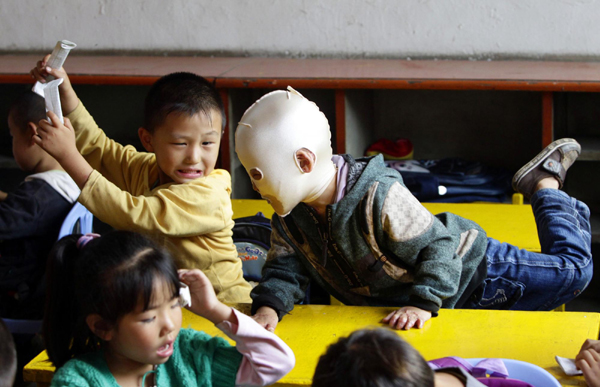Masked boy barred from kindergarten due to burns