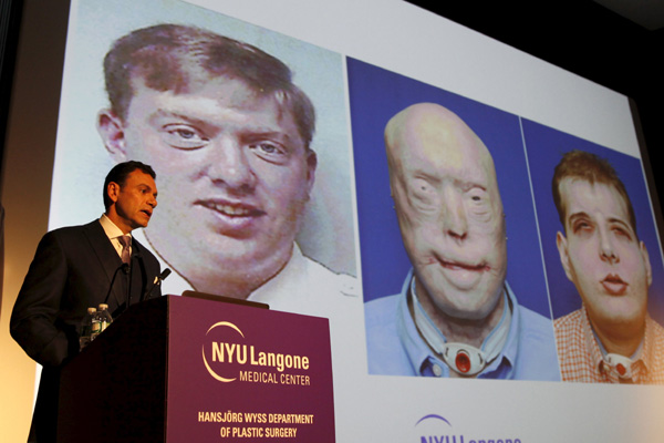 US firefighter gets world's most extensive face transplant